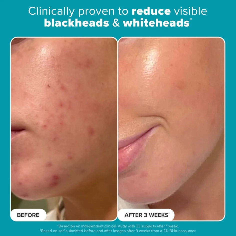Paula's Choice Skin Perfecting 2% BHA Liquid Exfoliant - Trial Size (30ml)