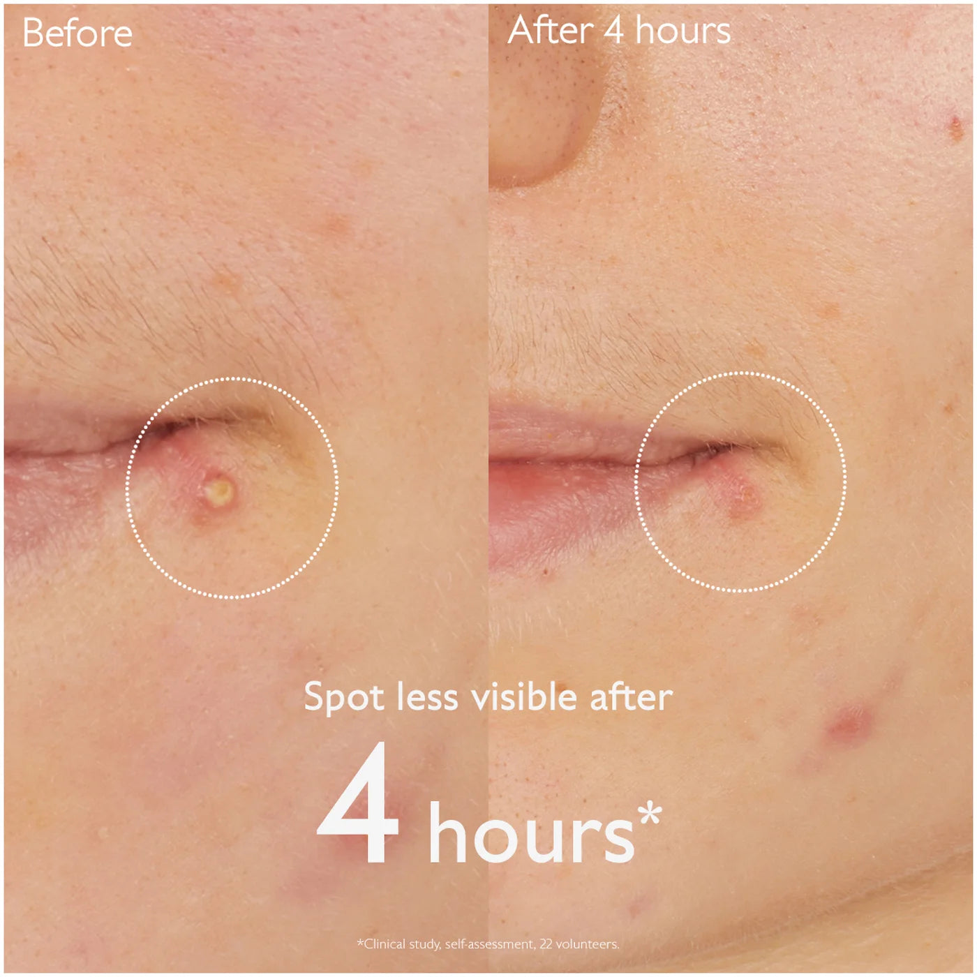 Caudalie Vinopure Salicylic Spot Solution 15ml